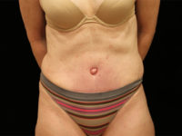 tummy tuck patient