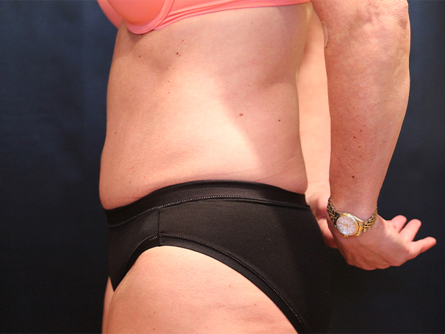tummy tuck patient