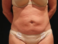 tummy tuck patient