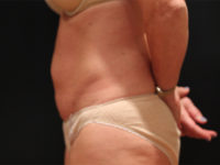 tummy tuck patient