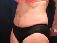 tummy tuck patient