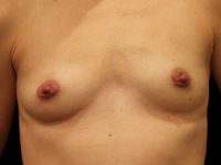 Before breast augmentation Greenwich, CT