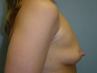 Before breast augmentation side Greenwich, CT