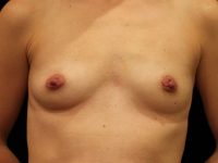 Before breast augmentation Greenwich, CT