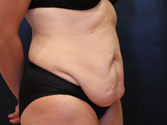 Before tummy tuck angle Greenwich, CT