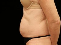 Before tummy tuck side Greenwich, CT