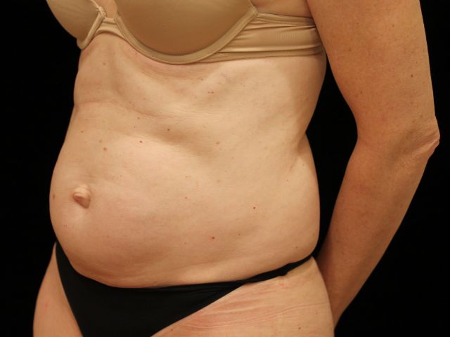 Before tummy tuck angle Greenwich, CT