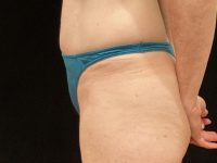 After tummy tuck side Greenwich, CT