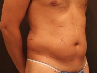 Before Liposuction Male Patient Diagonal Angle View Case 8800