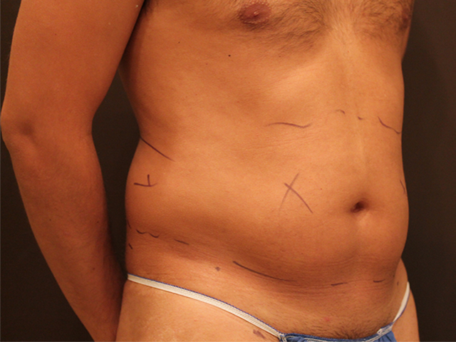 Before Liposuction Male Patient Diagonal Angle View Case 8800