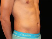 After Liposuction Male Patient Diagonal Angle View Case 8800