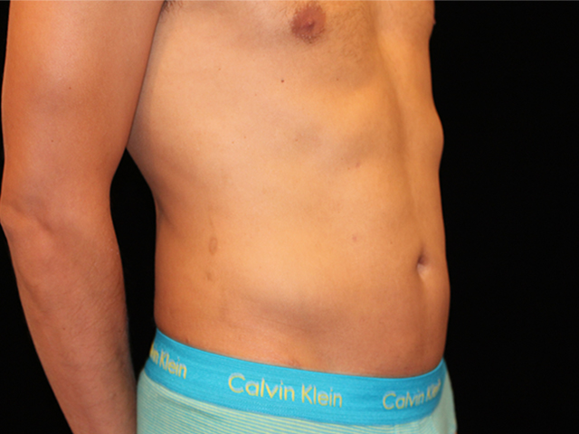 After Liposuction Male Patient Diagonal Angle View Case 8800