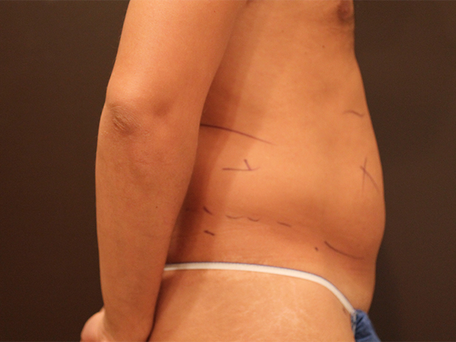 Before Liposuction Male Patient Side Angle View Case 8800