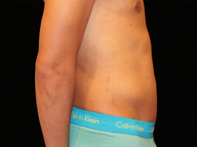After Liposuction Male Patient Side Angle View Case 8800