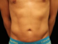 After Liposuction Male Patient Front Angle View Case 8800