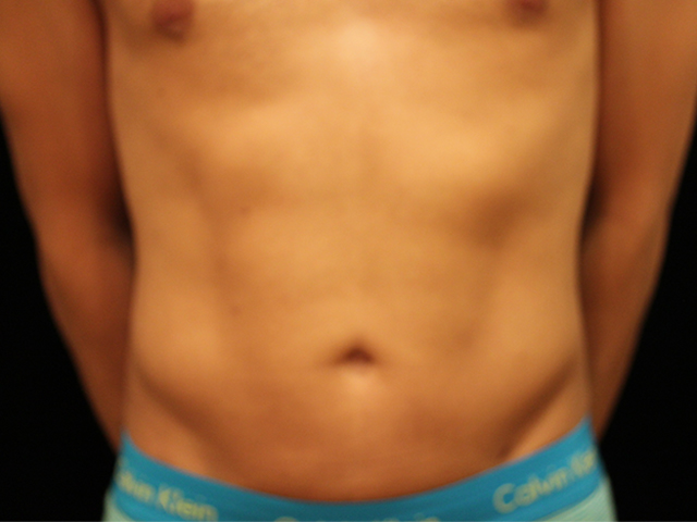 After Liposuction Male Patient Front Angle View Case 8800